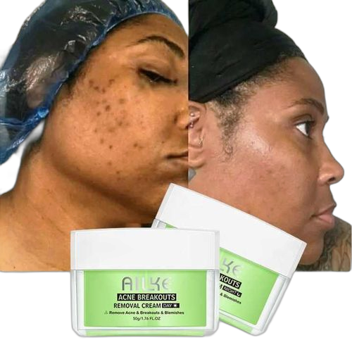 Creme visage ailke anti rides anti acne blanc