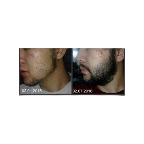 Kirkland minoxidil minoxidil 5% pousse barbe , une bouteille