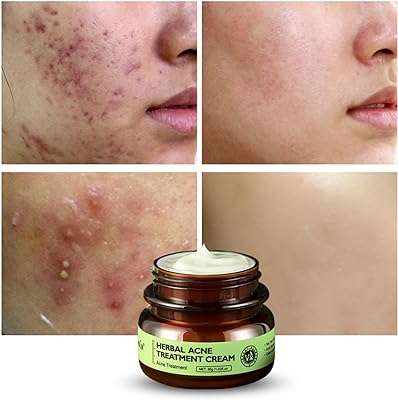 Jdlyever crème de traitement de l'acné à base de plantes 30 ml efficace pour traiter. Laissez-vous séduire par DIAYTAR COTE D'IVOIRE, votre boutique en ligne qui saura vous offrir des produits de qualité à des prix compétitifs. Que vous recherchiez des équipements pour la maison, des appareils électroménagers, des accessoires informatiques ou des articles de mode tendance, vous trouverez tout cela et bien plus encore dans notre sélection discount.
