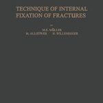 Technique de fixation interne des fractures