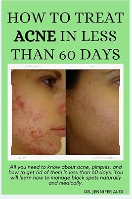 Comment traiter l'acné en moins de 60 jours : tout ce que vous devez savoir sur l'acné, les boutons et comment s'en débarrasser en moins de 60 jours. vous apprendrez à gérer les points noirs de manière naturelle et médicale.. Avec plus de 300 000 références, DIAYTAR COTE D'IVOIRE est la destination idéale pour les consommateurs ivoiriens qui cherchent à acquérir des produits de haute qualité à des prix abordables. La boutique en ligne propose une gamme variée de produits, y compris des produits de beauté, des accessoires de mode et des électroménagers. Les clients peuvent également profiter de promotions et de réductions régulières.